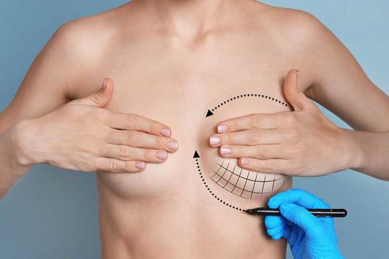 Breast Augmentation (Implants)