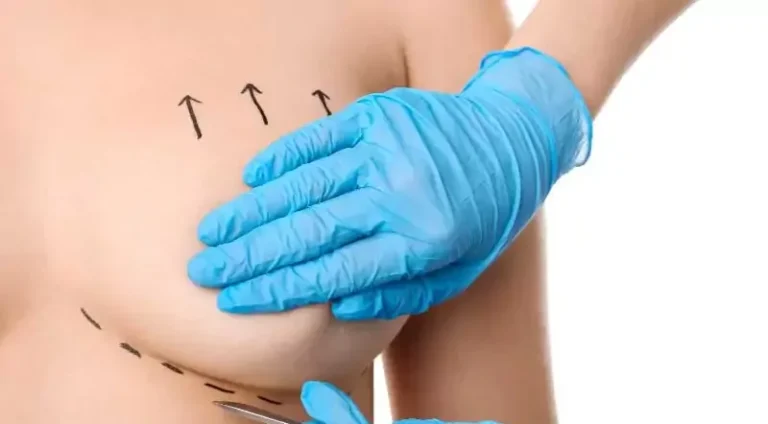 Breast lift