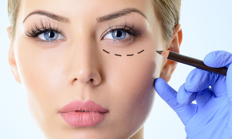 Lower eyelid blepharoplasty under local anesthesia