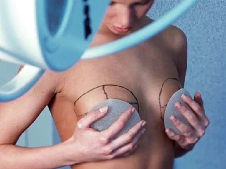 Breast lift (with implants)