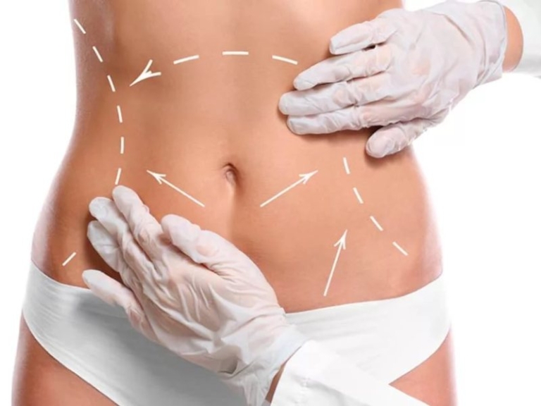 Mini Abdominoplasty