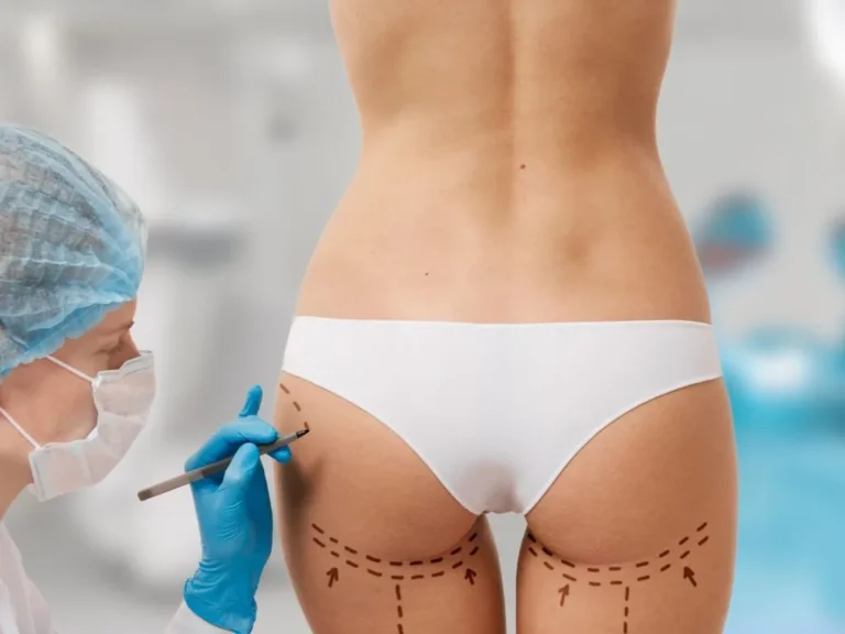 Gluteoplasty (Butt implant)